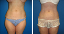Before & After Photos